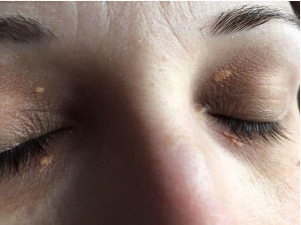 xanthelasma xanthelasma
