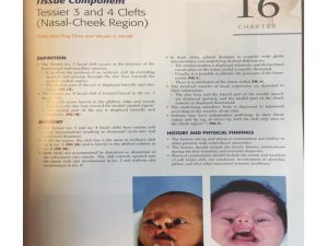 Clefts nasal cheek region