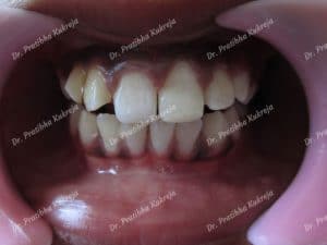 case 2: composite restorations for fractured teeth after