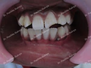 Composite Restoration - fractured teeth