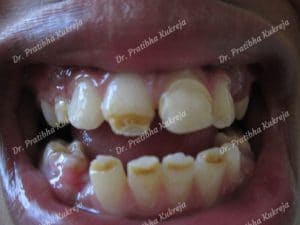 case 1 - composite restorations before