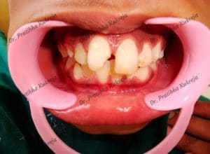 dental avulsion with composite restoration