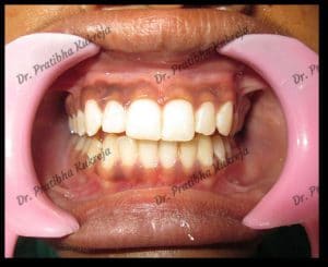 Results after the treatment of fractured tooth