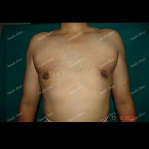 Gynecomastia case 1 after