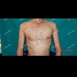 Case 2: Gynaecomastia After