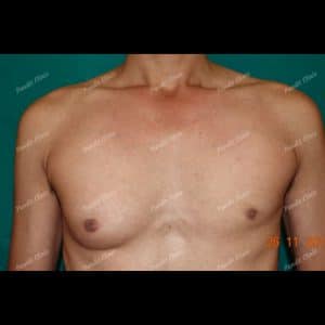 Gynecomastia Case 2 Before