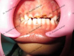Pulpectomy-in-front-teeth-case-2