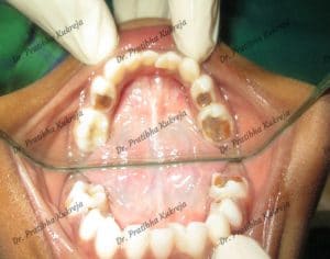 pulpectomy procedure for decayed teeth