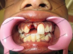 tooth avulsion case 1