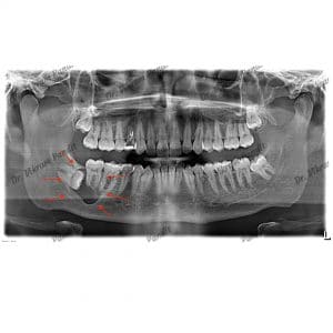 cyst - wisdom tooth