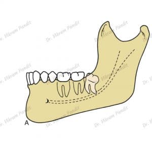 Wisdom tooth - distoangular impaction