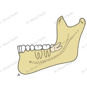 wisdom tooth horizontal impaction