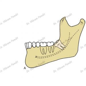 mesioangular impaction