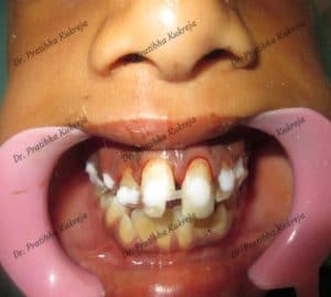 tooth avulsion fixed with splint