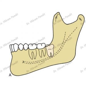 vertical impaction - wisdom tooth