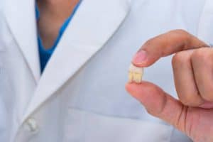wisdom tooth extraction