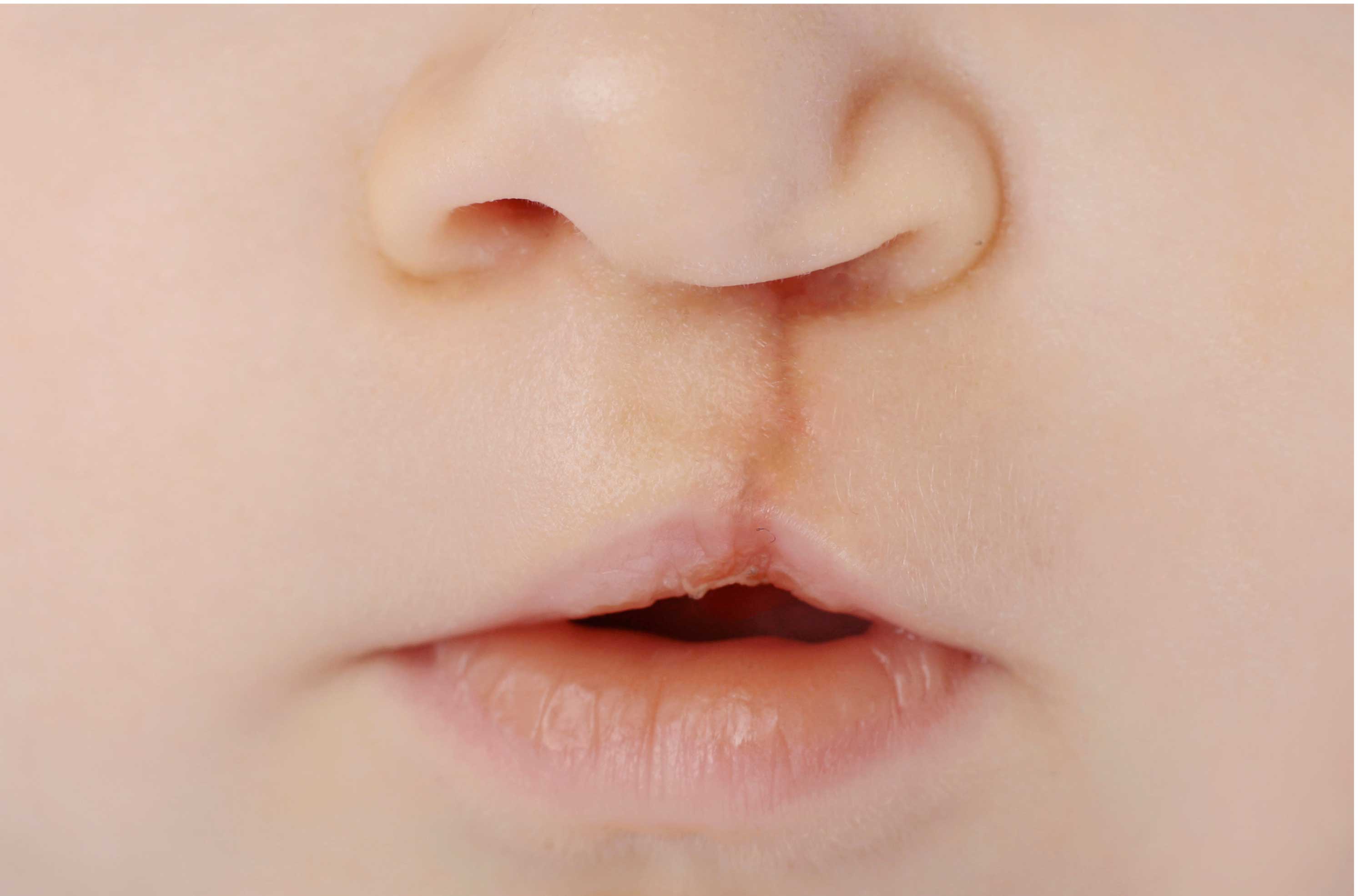 cleft rhinoplasty at Pandit Clinic