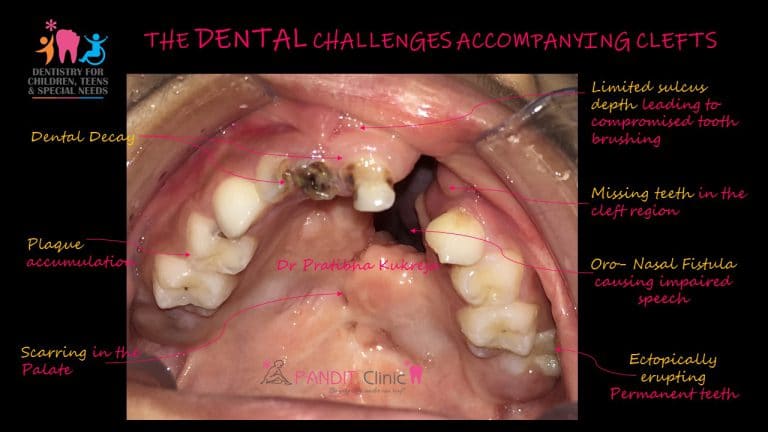 Cleft Challenges by Dr. Pratibha Kukreja Pandit