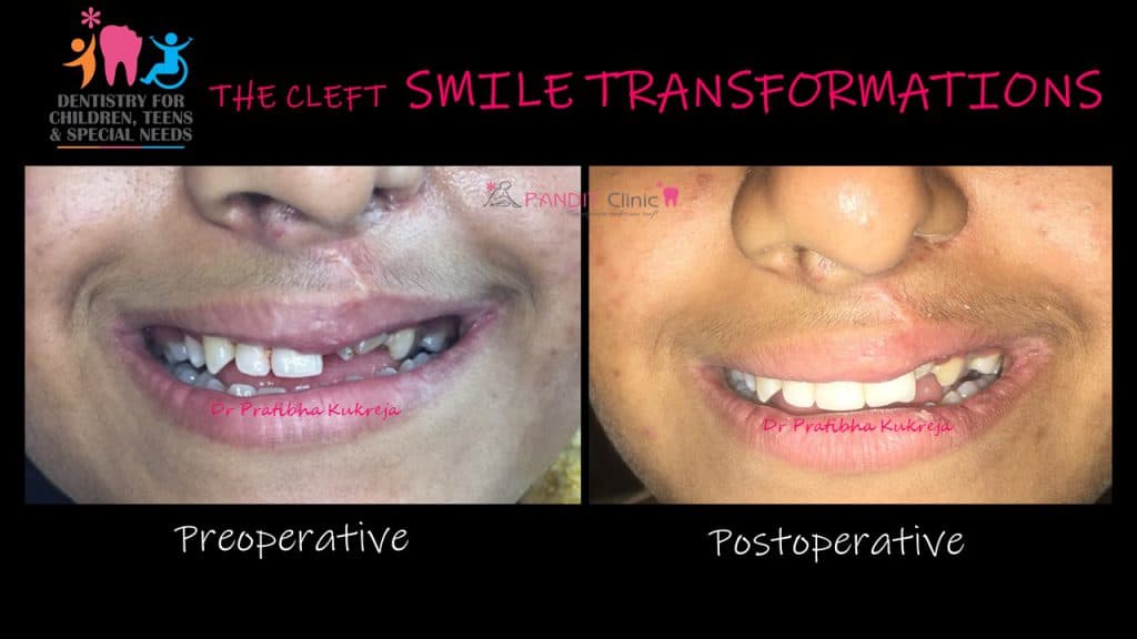 cleft smile by Dr Pratibha Kukreja