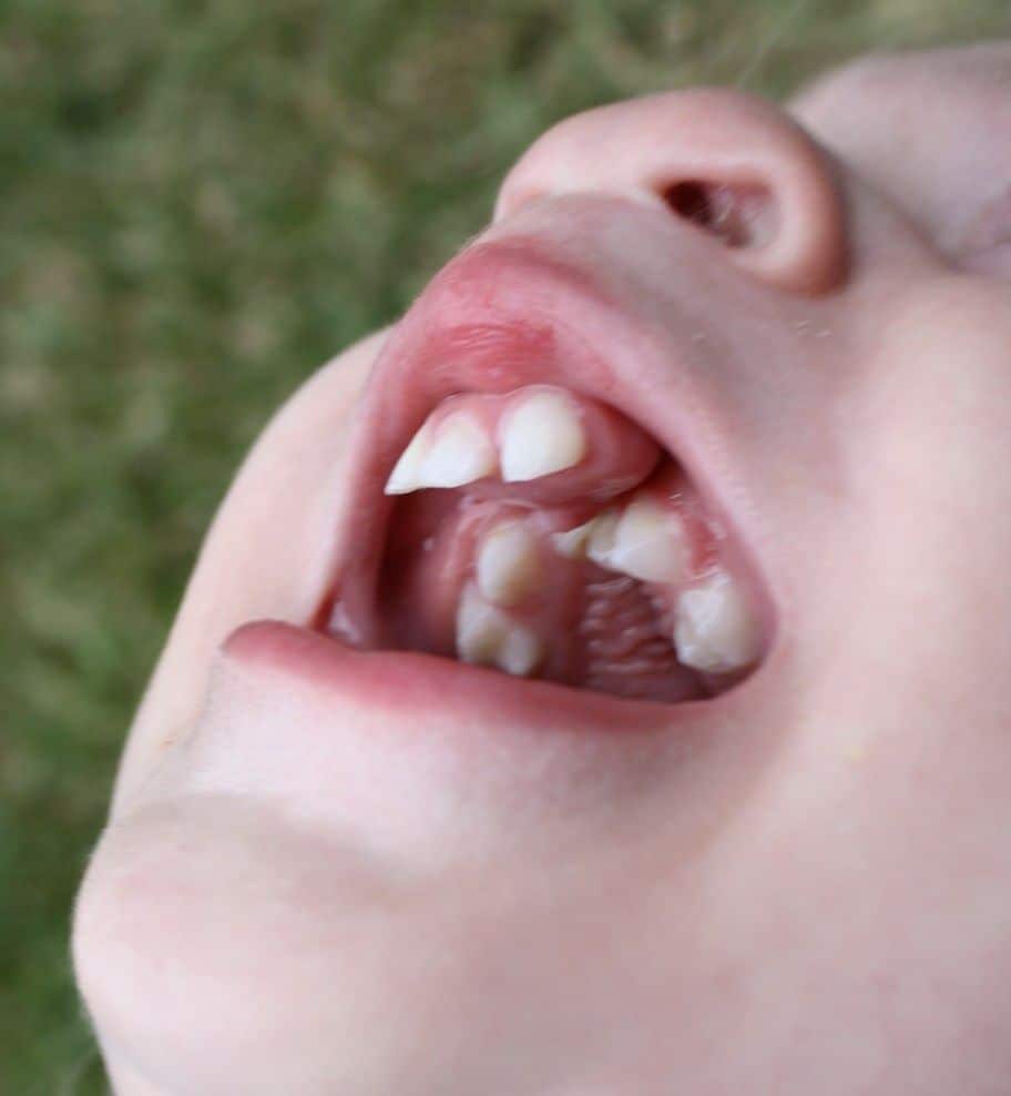 Dental Care For Cleft Lip