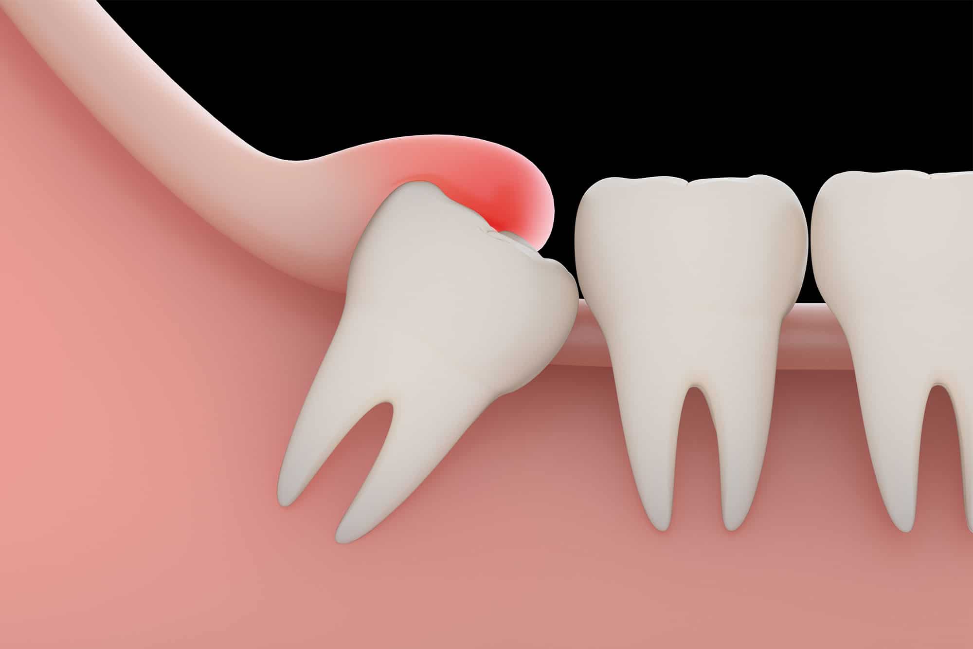 Read more about the article Wisdom Tooth Removal