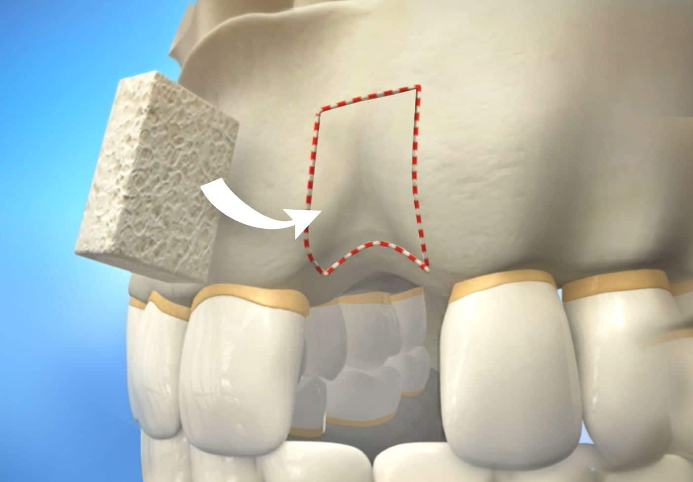 Read more about the article Alveolar Bone Grafting: Overview of Procedure