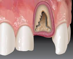 alveolar bone grafting