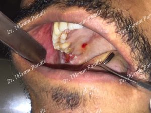 wisdom teeth case 2 with cheek ulcer