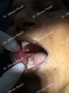 wisdom teeth implant cheek ulcer