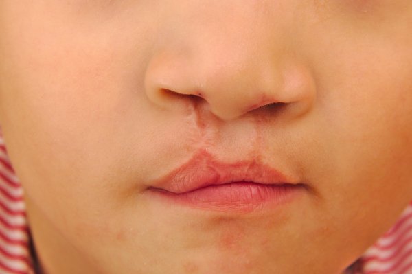 Cleft lip and palate