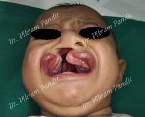 right complete unilateral cleft lip and palate with alveolar defect