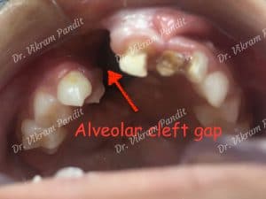 cleft-alveolus-at-young-age