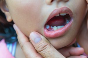 root canal treatment for kids