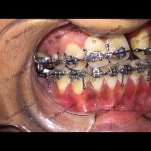 cleft orthoganithic - orthodontics - 1