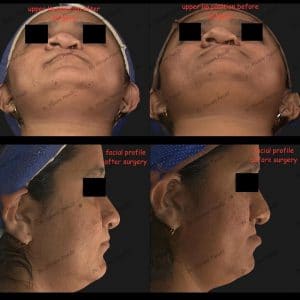 cleft orthognathic case 1