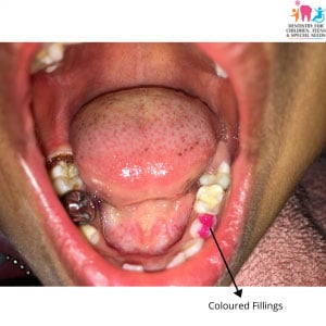 tooth colored fillings