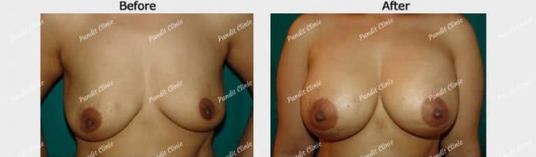 breast augmentation surgery case 1 Pandit Clinic