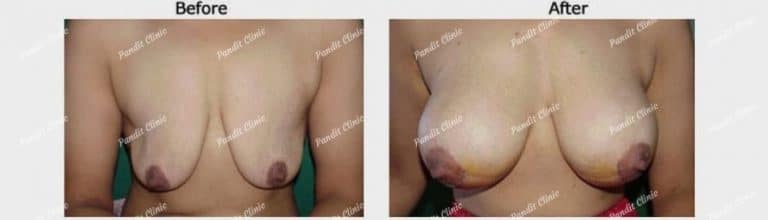 breast augmentation surgery case 2 Pandit Clinic