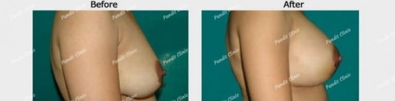 breast augmentation case 3 side view Pandit Clinic