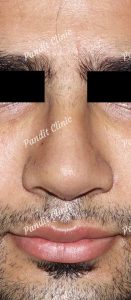 case-1-rhinoplasty-after-pandit-clinic