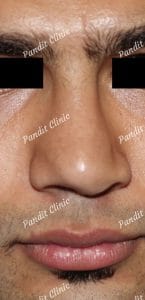 case-1-rhinoplasty-before-pandit-clinic