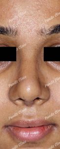 case-2-rhinoplasty-after-pandit-clinic