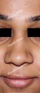 case-2-rhinoplasty-before-pandit-clinic