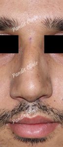 case-3-rhinoplasty-after-front-view-pandit-clinic