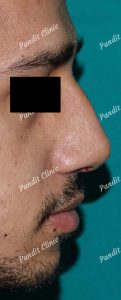 case-3-rhinoplasty-after-pandit-clinic