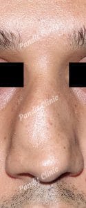 case-3-rhinoplasty-before-front-view-pandit-clinic
