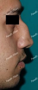 case-3-rhinoplasty-before-pandit-clinic