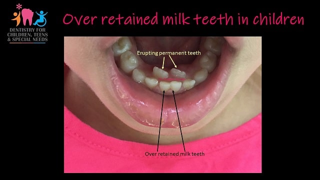Over-Retained-Teeth