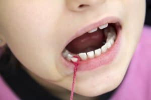 tooth extraction in children