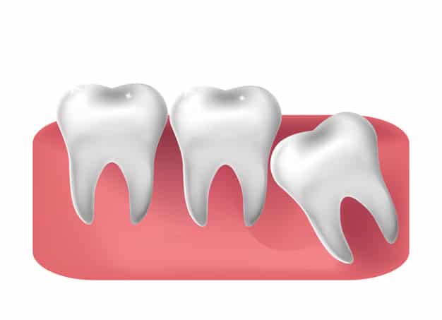 Periodontal-Disease